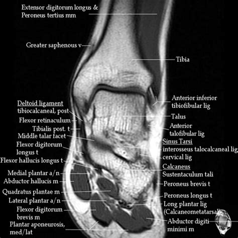 Deltoid Ligament Ankle Mri