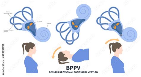 Semicircular Menieres Ear Canal Benign Paroxysmal Positional Vertigo