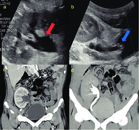 Ultrasound Images A And B Show Dilatation Of The Pelvicalyceal System