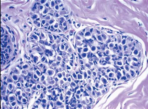 Lobular Carcinoma in Situ and Atypical Lobular Hyperplasia | Oncohema Key