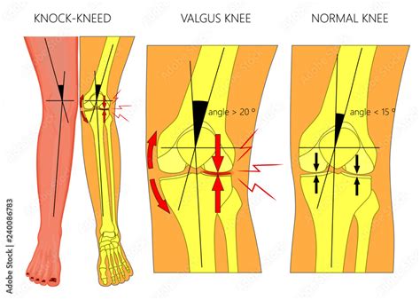 Vector Illustration Diagram Shapes Of Human Legs Normal And Curved