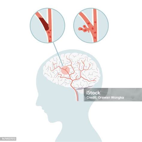 Ischemic Stroke And Hemorrhagic Stroke Stroke Brain Concept In Flat