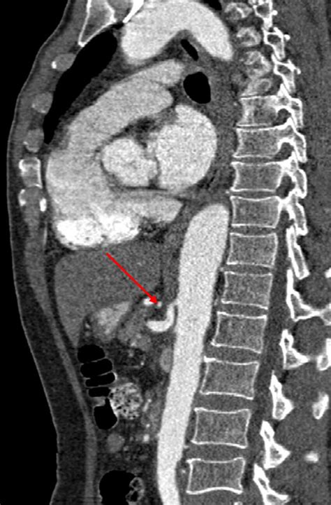 Sagittal reformatted CT aortogram image at the level of CA origin. Note ...