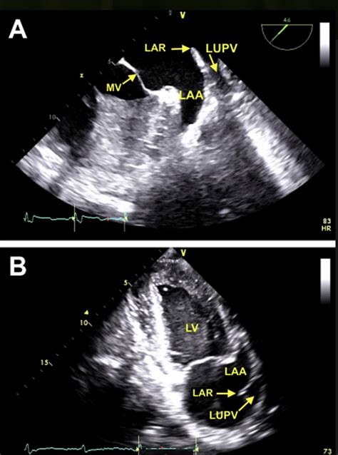 The Anatomy Of The Coumadin Ridge Journal Of The American Society Of