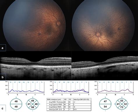 Sd Oct Scan Findings A Wide Field Retinal Imaging Showing