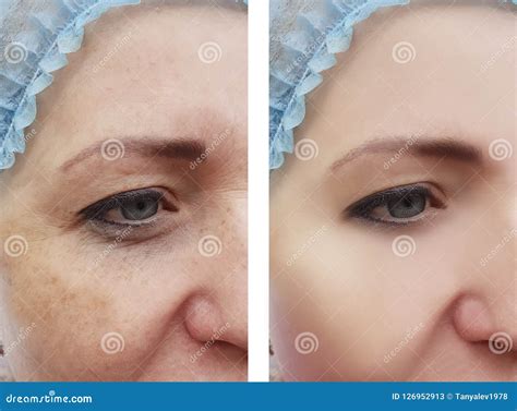 Woman Face Wrinkles Pigmentation Removal Health Before And After