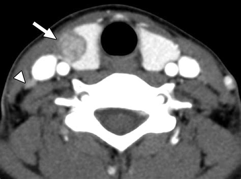 Preoperative Staging Of Papillary Thyroid Carcinoma Comparison Of