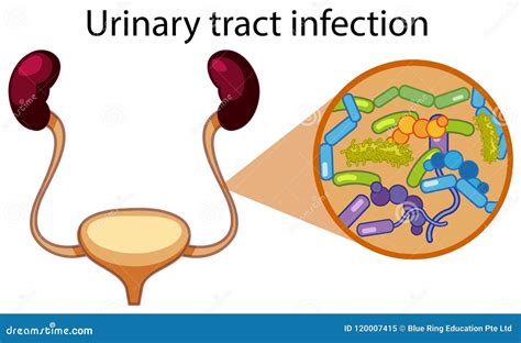 Infección De Vías Urinarias Humana Ilustración Del Vector Ilustración De Vector Cuadro 120007415