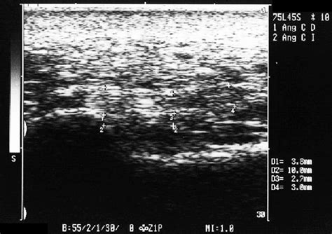 Sagittal ultrasound image showing the plantar fascia origin, with ...