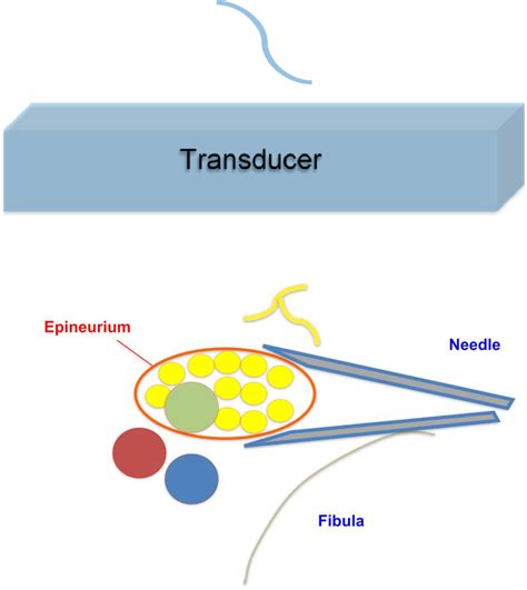 Figure 5 From Ultrasound Guided Nerve Hydrodissection For Pain Management An Updated Review Of