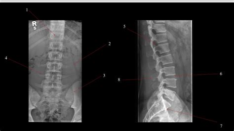 Lumbar Spine Xray