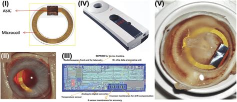 Capacitative Iop Sensors Implanted In The Capsular Bags I Image Of