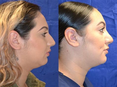 Nose Surgery Before And After Photos Patient 194 San Francisco Ca Kaiser Permanente Cosmetic