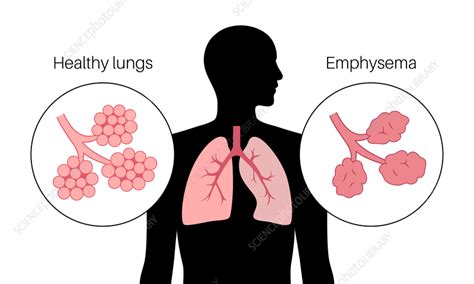 Emphysema Illustration Stock Image F Science Photo Library