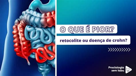 Retocolite Ulcerativa Versus Doen A De Crohn Qual Pior