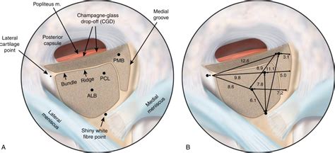 Meniscal Root Tears Musculoskeletal Key