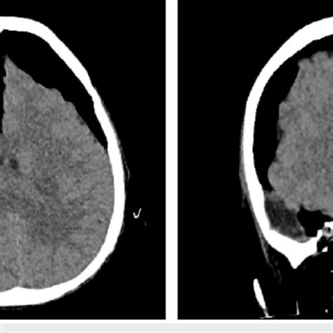 Diffuse Pneumocephalus Which Was Intensely Localized At The Subdural