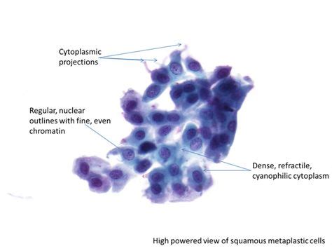 23 Cytology ideas | pap smear, anatomy and physiology, squamous cell