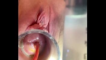 W 4cc Inflation Of Catheter Balloon Inside Cervix XVIDEOS