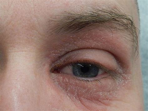 how to treat dry skin around eyes 3