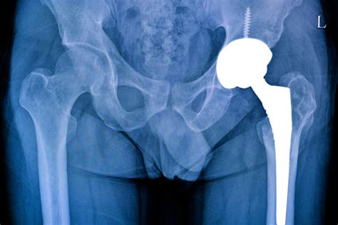 Hip replacement surgery: All you need to know - AwayDoc