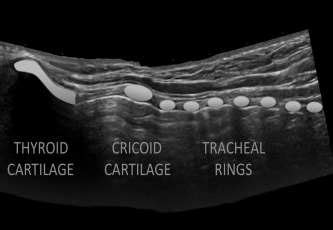 E String Of Pearls On Longitudinal US Of Airway Notice The