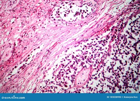 Testicular Seminoma Light Micrograph Stock Photo Image Of Medicine