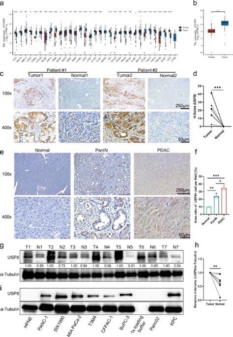 New Idea For Pancreatic Cancer Therapy Targeting Usp Enhances Pd L