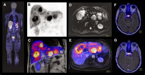 MRI and Medical Imaging: MR-PET: A new approach in molecular imaging