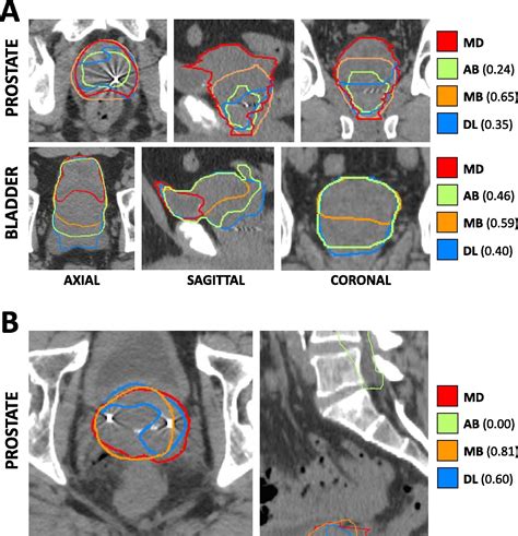 PROSTATE ANATOMICAL EDGE CASES The Cancer Imaging Archive TCIA