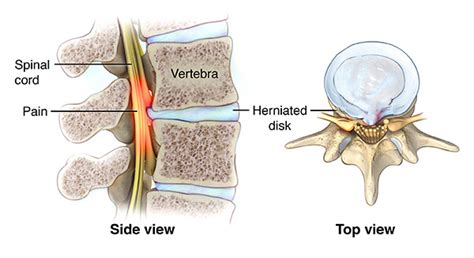 Myelopathy - ONZ Spine