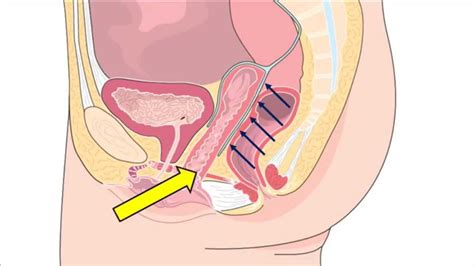 Balloon Assisted Laparoscopic Sacrocolpopexy Bals Youtube