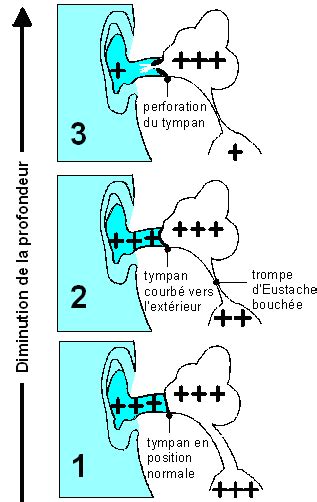 Osml Plong E Th Orie Niv Ii Les Barotraumastismes