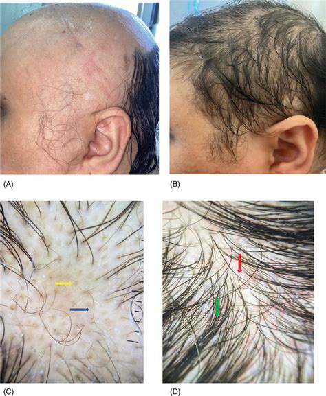 Microneedling Case 38year Old Female Showing Large Patches Of Alopecia