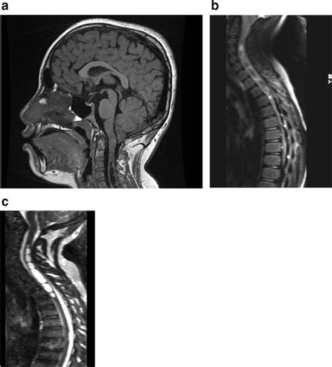 Preoperative magnetic resonance imaging (MRI) evaluations. a Sagittal ...