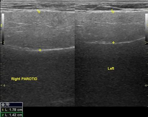 Acute Parotitis Radiology Case