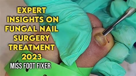 Expert Insights On Fungal Nail Surgery Restoring Healthy Nail By