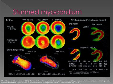 Takotsubo Cardiomyopathy Ppt Download