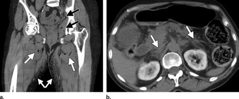 Necrotizing Retroperitoneal Fasciitis With Indirect Spread From The Download Scientific Diagram