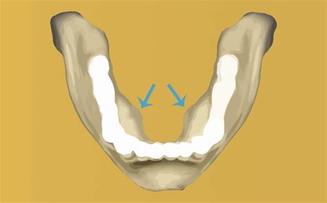 Tori Removal or Reduction – Britten Perio