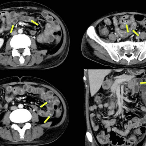 Abdominal Ct Scan Revealed Diffuse Edematous Change Of Gastrointestinal