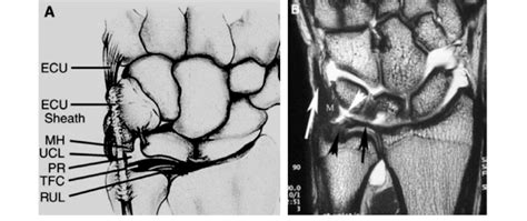 Coronal Section Of Tfcc Anatomy Ecu Extensor Carpi Ulnaris Tendon