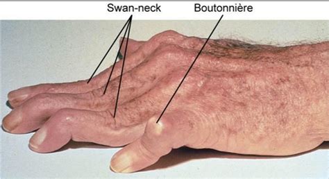 Musculoskeletal Abnormalities Of Wrist And Hand Conditions Caused By