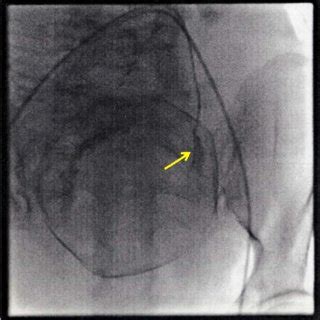 Fluoroscopic Findings Confirming The Placement Of The Occlusion