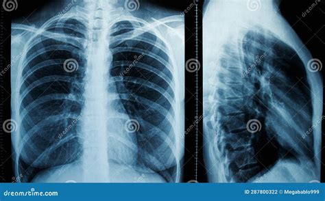 Frontal And Lateral Projections Of A Female Chest X Ray Stock Photo