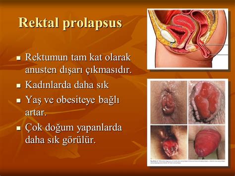 Hemoroidal Hastal K Anatomi Ve T Bbi Tedavide Anahtar Kavramlar Ppt Indir