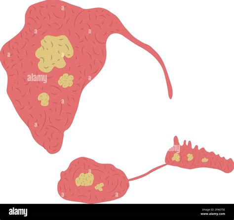 Vector Illustration Of Stones In The Salivary Glands Sialolithiasis