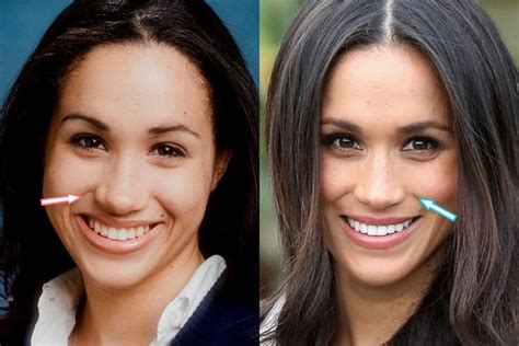 Meghan Markle Plastic Surgery – Nose Job, Teeth - before and after ...