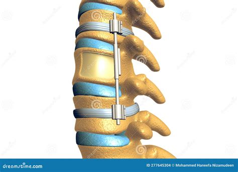 Spinal Fixation System Titanium Bracket Medically Accurate Stock