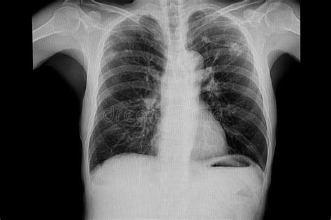 Chest Xray Of A Patient With Old Tb Stock Photo Image Of Disease